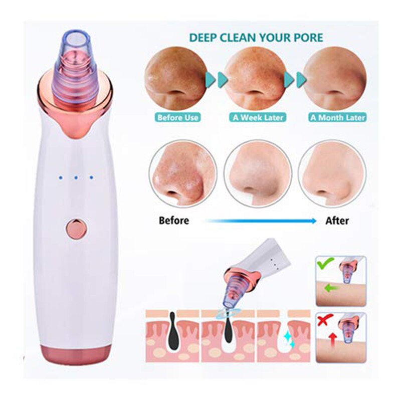 Facial Blackhead and Pore Remover Pore