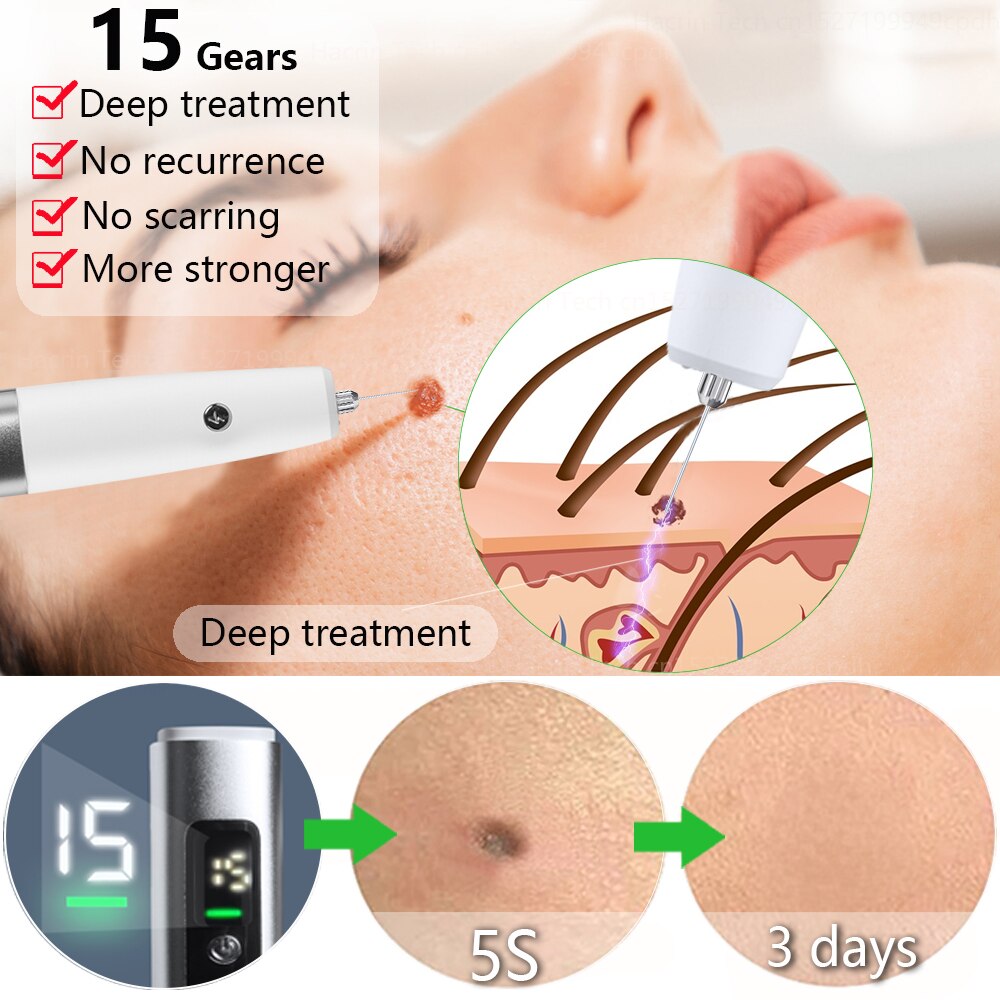 Electric Skin Tag Remover