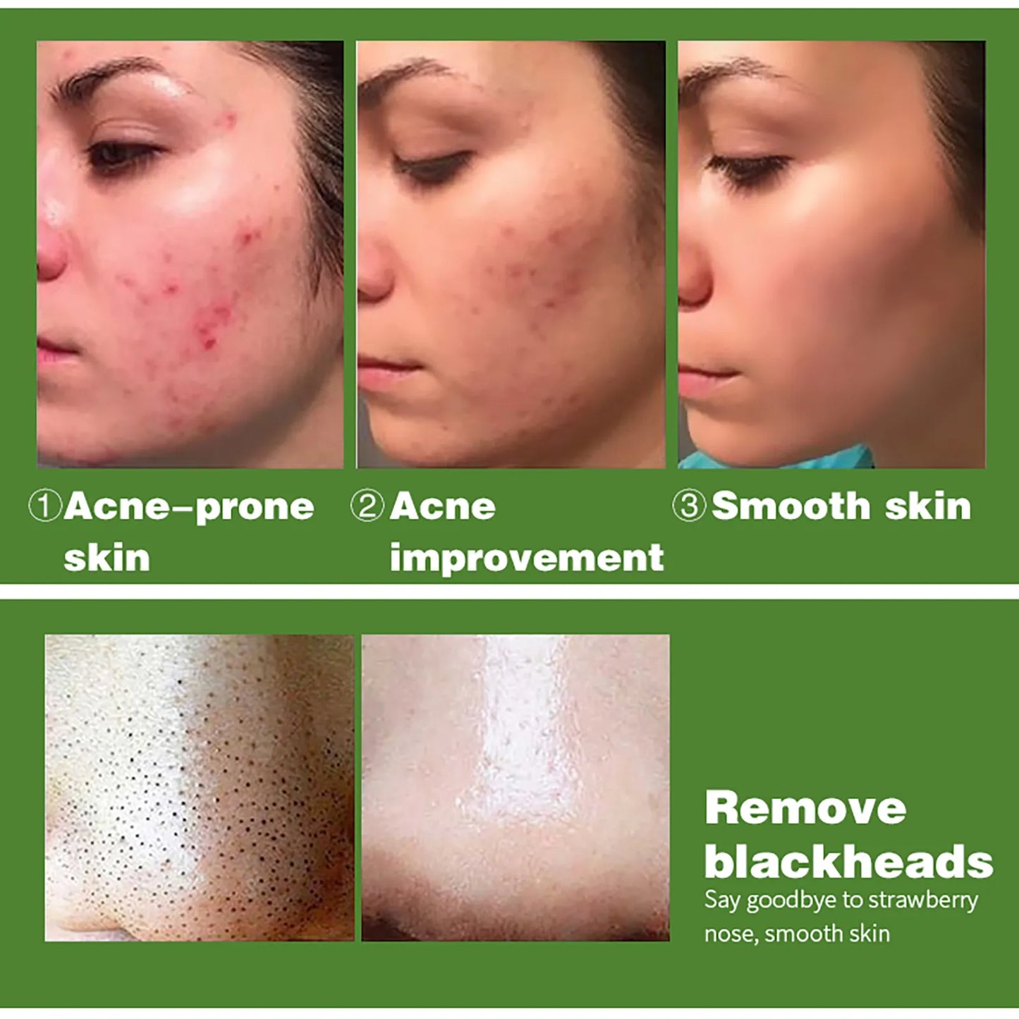 AILKE Salicylic Acid Acne Treatment Serum